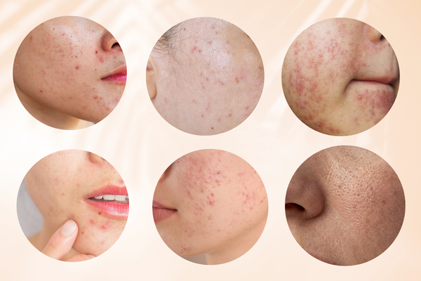 Da dầu mụn nên dùng sửa rửa mặt nào để cải thiện làn da